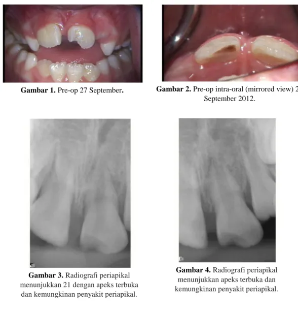 Gambar 1. Pre-op 27 September.  Gambar 2. Pre-op intra-oral (mirrored view) 27  September 2012