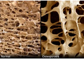 Gambar 01. Tulang normal dengan tulang yang mengalami osteoporosis