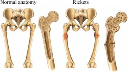 Gambar 02. Perbedaan anatomi tulang normal dan ricketsia 