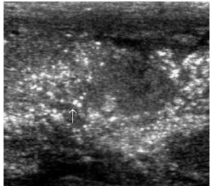 FIGURE 19. Normal placental calciﬁcation.
