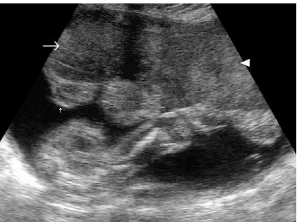 FIGURE 1. Chronic hypertrophic placentitis. Observe themarked heterogeneous echogenic thickening of the chorionicplate (small vertical arrow), along with hypoechogenic areas ofthe villous mass (large horizontal arrow)