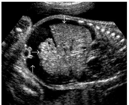 FIGURE 8. Two-dimensional ultrasound image of fetal femurwith local bone destruction (arrow).