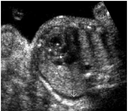 FIGURE 12. Fetus with pleural effusion. Observe thecalciﬁcations in the heart. Cardiac calciﬁcations are a direct signof an inﬂammatory process