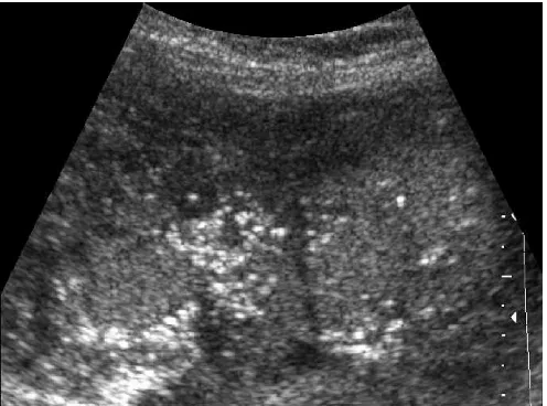 FIGURE 15. Foci of chronic placentitis in a grade I placenta.Observe the peripheral echogenic clusters of microabscessesand areas of ring formation (arrow) typical of maturegranulomas.
