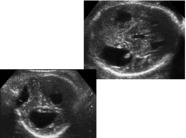 FIGURE 17. Fetus at 22th week of gestation with toxoplasmosis.There is bilateral ophthalmitis with condensation of the vitreoushumor, cataracts (upward arrow), and retinal calciﬁcations(downward arrow).