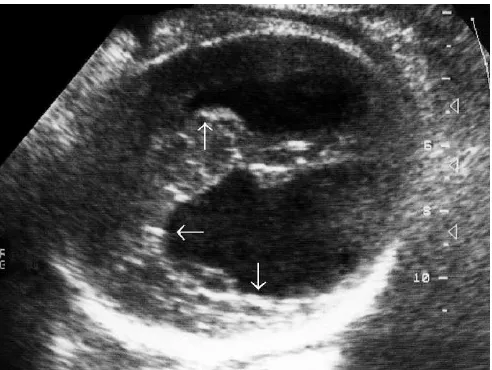 FIGURE 18. Pregnancy at 34th week of gestation with fetaltoxoplasmosis. The fetus has severe, chronic encephalitis.Observe the asymmetric cerebral atrophy with calciﬁcations ofthe ventricular walls (horizontal arrow) and the cerebralparenchyma (vertical up