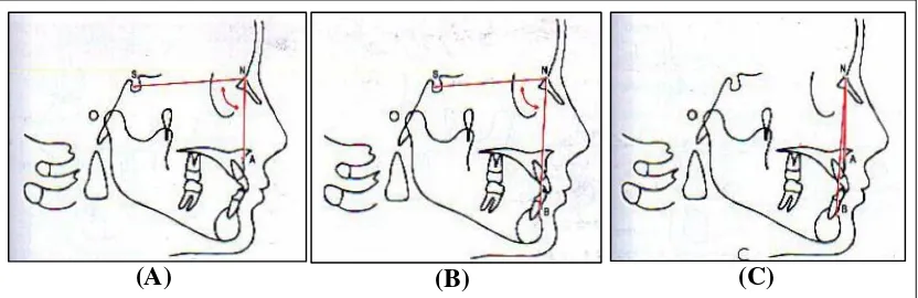 Gambar 4. Analisis Skeletal Steiner (A)  Sudut SNA; (B) Sudut SNB; dan (C) Sudut ANB.12 