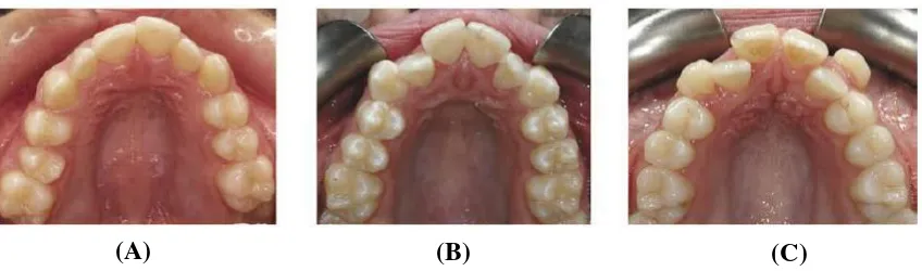Gambar 2. Tingkat Keparahan Gigi Berjejal (A) Gigi Berjejal Ringan; (B) Gigi Berjejal  