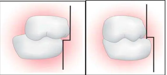 Gambar 6. Hubungan molar desidui : (A) Relasi mesial step (B) Relasi distal step25 