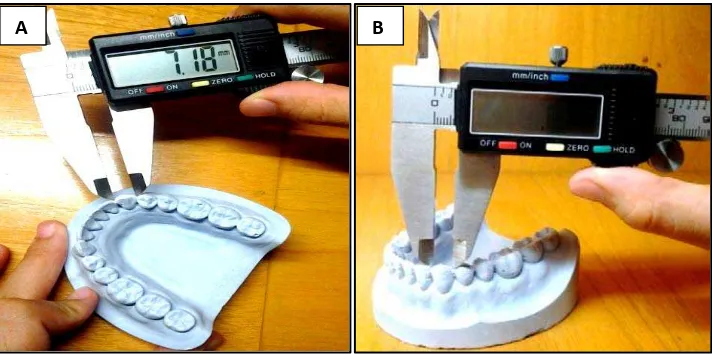 Gambar 10. Cara pengukuran mesiodistal gigi menggunakan metode : (A) Moorrees; (B) Mullen