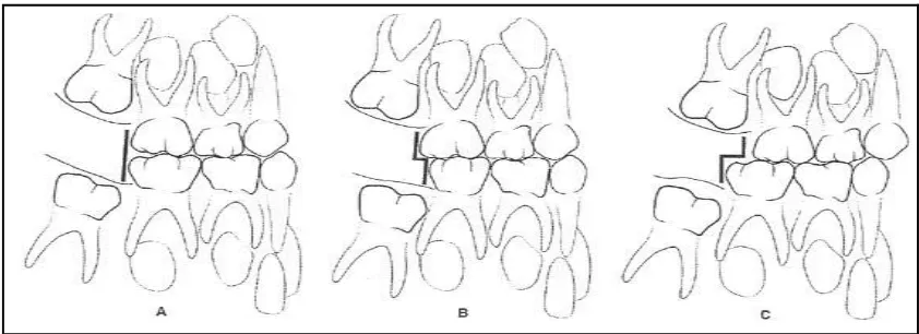 Gambar 6. Hubungan  molar kedua gigi desidui: (A) Flush terminal plane; (B) Mesial step; (C) Distal step23 