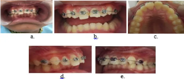 Gambar 4. a. Pembersihan soket menggunakan larutan saline, b. Replantasi gigi 11, c. Fiksasi gigi  menggunakan orthodontic bracket 