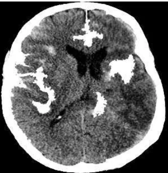 Gambar 2.3. Pendarahan Otak Subdural (https://radiopaedia.org) 