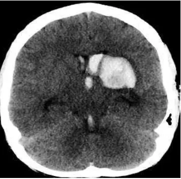 Gambar 2.5. Pendarahan Otak Intracerebral (https://radiopaedia.org) 