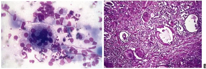 Gambar 2.7. Tiroiditis de Quervain. A. Gambaran sitologik, tampak multinucleated giant cell dikelilingi oleh debris (pewarnaan Diff-Quik)