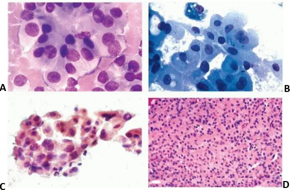 Gambar 2.12.  Tumor sel Hürthle dengan berbagai pewarnaan. A. May-Grünwald-Giemsa (MGG), B