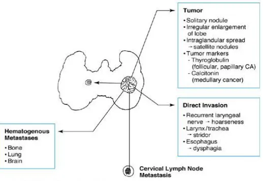 Gambar 2.2.  Manifestasi klinis karsinoma tiroid 10 