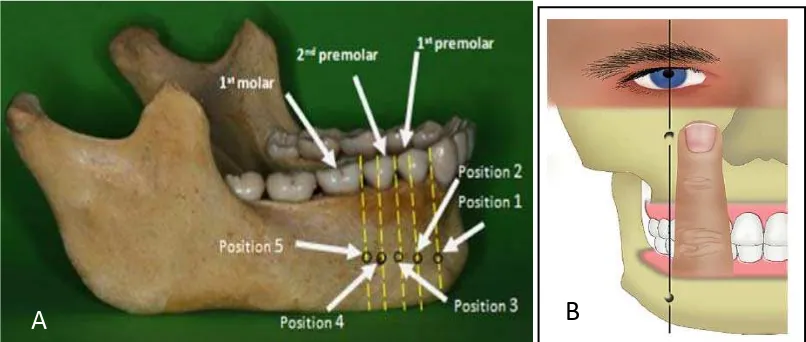 Gambar 5. Penentuan posisi foramen mental. A) Relasi vertikal terhadap aksis    mandibula23; B) Pupil mata atau lebar satu jari tangan17 