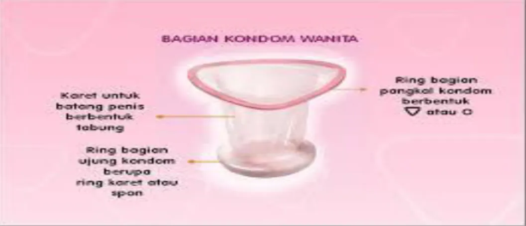 Gambar 2.1 Kondom Wanita 