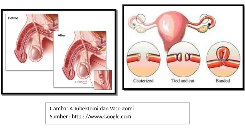 Gambar 4 Tubektomi dan Vasektomi