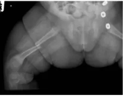 Gambar 1.Fraktur Patologis yang disebabkan oleh Osteopenia Prematuritas (Itani etal., 2006).