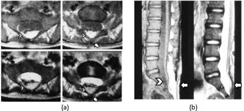 Gambar 3. (a) MRI Lumbosakral T1WI& T2WI potongan axial (tanda panah = defek lamina posterior L5-S1, ujung panah = struktur lipoma); (b) MRI Lumbosakral T1WI dan T2WI potongan sagital(ujung panah = conus medularis yang letaknya terlalu ke bawah yaitu setinggi vertebra L5-S1, tanda panah=struktur lemak yang berdekatan dengan conus medularis)