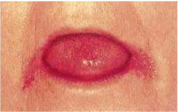 Gambar 6. Angular Cheilitis6 