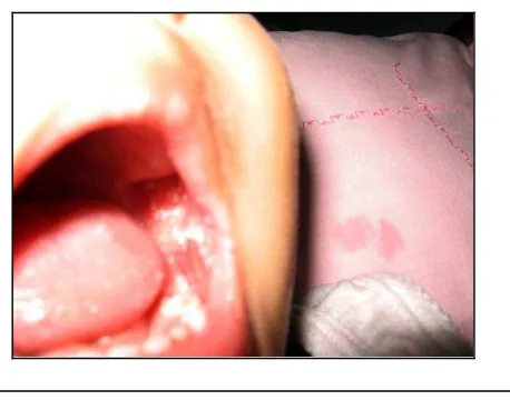 Gambar 8. Bercak keputihan pada mukosa pipi, palatum, dan lidah pasien, dapat dihapus menggunakan  
