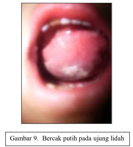 Gambar 9.  Bercak putih pada ujung lidah 