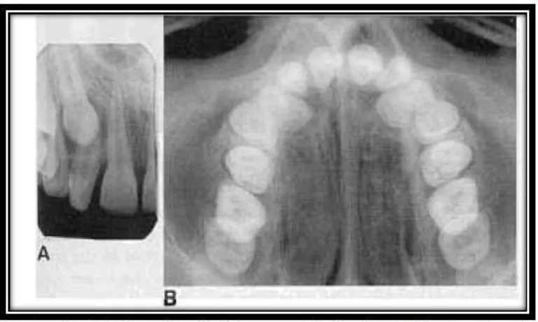 Gambar 4. (A) Radiografi periapikal memperlihatkan impaksi kaninus berada di apikal diantara akar insisivus lateral dan premolar pertama