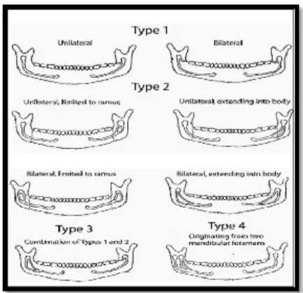 Gambar 7. Klasifikasi bifid mandibular canalmenurut Langlais28