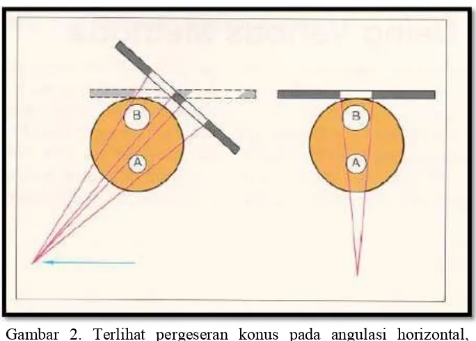 Gambar 2. Terlihat pergeseran konus pada angulasi horizontal, menunjukan suatu obyek A dan B dengan pergeseran konus ke arah distal