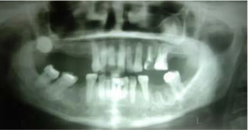 Gambar 1. Gambaran lesi campuran radiopak dan radiolusen berbatas tegas pada  gigi 25 dan 26 