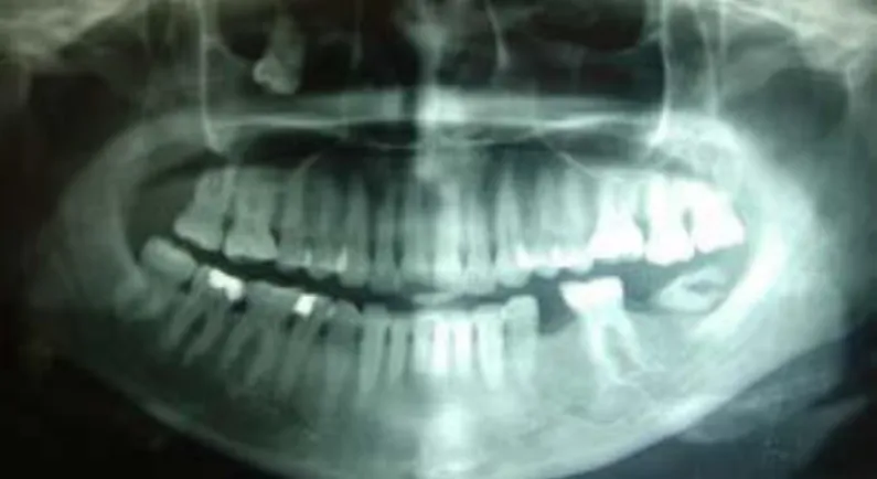 Gambar 2. Hasil radiografi panoramik ditemukan adanya impaksi pada gigi 28 disertai  radiolusen berbatas tegas di sekitar gigi yang impaksi 