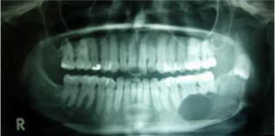 Gambar 3. Gambaran multilokuler radiolusen pada region premolar kedua hingga kondilus  pada sisi kanan mandibula 