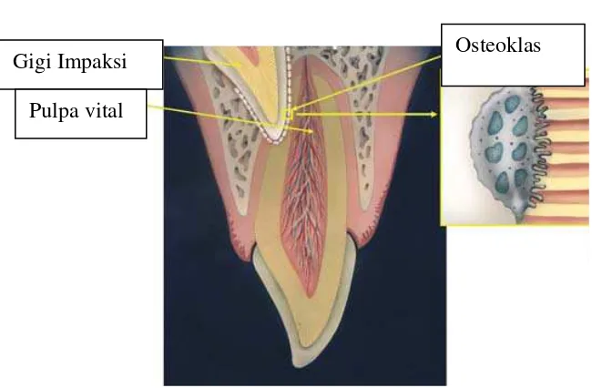 Gambar 6.     Resorpsi akibat perawatan ortodonti A. Foto radiografi dari resorpsi akar akibat perawatan ortodonti
