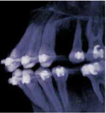 Gambar 19. Penggunaan CT scan untuk melihat bentuk tiga dimensi dari gigi, akar dan tulang alveolar31 