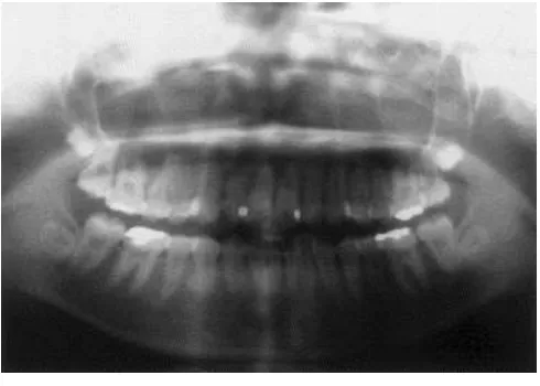 Gambar 20. Foto panoramik sebelum perawatan menunjukkan tidak adanya resorpsi akar pada seluruh gigi.13 