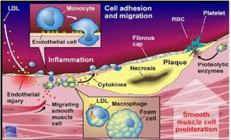 Gambar 4. Proses Plak Aterosklesosis (Cefalu, 2006)
