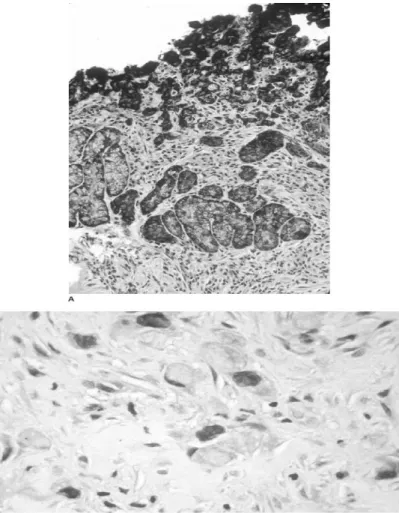 Gambar 2.6 Histopatologi Adenocarcinoma Gaster 