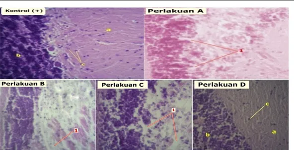 Gambar 1 Histopatologi otak kerapu tikus (Cromileptes altivelis) yang terinfeksi VNN dengan pewarnaan H-E dan perbesaran 400x