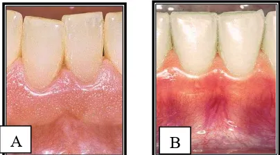 Gambar 2. A. Gingiva tebal;  B. Gingiva tipis.      17