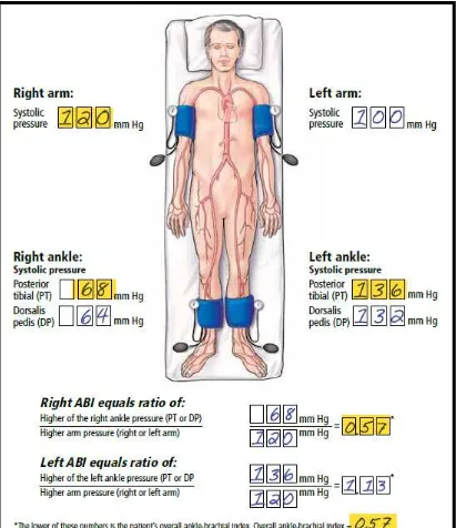 Gambar 2. Cara perhitungan ABI (Ankle Brachial Index) 