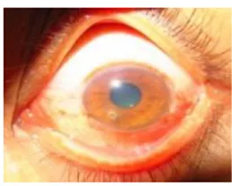 Gambar 2.  Follow up kasus 1 hari kedua preop dan  USG OS: vitreous keruh di anterior, retina intak