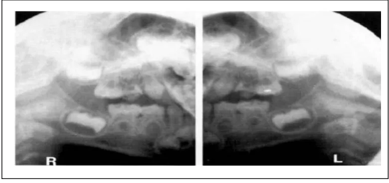 Gambar 9. Gambaran radiografi dengan teknik bimolar memperlihatkan gigi-geligi pada sisi     kanan dan kiri rahang pada bagian yang berbeda dari radiografi yang sama