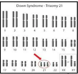 Gambar 2.1Karyotipe anak sindrom Down15 