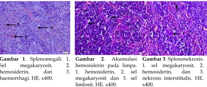 Gambar  1.  Splenomegali.  1. Sel  megakaryosit,  2. hemosiderin,  dan  3. haemorrhagi