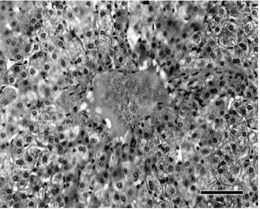 Gambar 2.7 Degenerasi parenkimatosa dan deskuamasi sel-sel epitel tubulus 