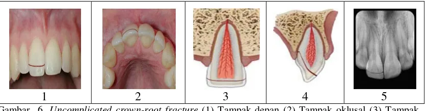 Gambar 4. Uncomplicated crown fracture (enamel-dentin fracture) (1) Tampak depan (2)        