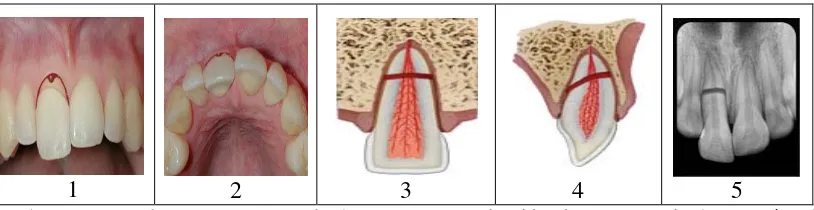 Gambar 8. Root fracture (1) Tampak depan (2) Tampak oklusal (3) Tampak depan animasi                (4) Tampak lateral animasi (5) Gambar  radiografi.22 
